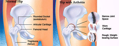 Painful / Worn Hip replacement — Gormack Orthopaedics